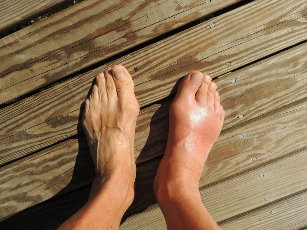 Do You Have Gout? What Is Gout and What Causes It?